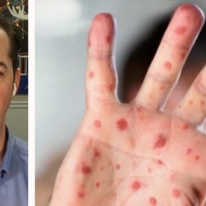 Measles in Canada | Infection is 'most transmissible' on the planet